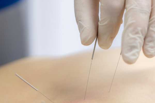 acupuncture during pregnancy